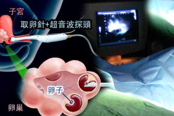 广州本地找供精靠谱的医院,广州供精试管要不要排队_试管婴儿代孕